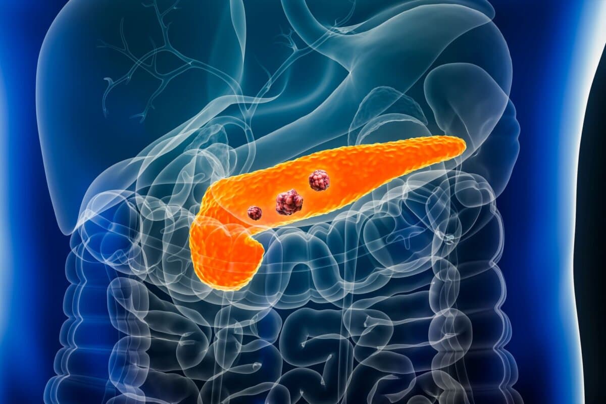 Pankreaskarzinom, Illustration.