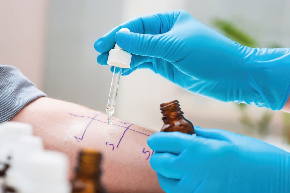 Pricktest zur Allergiediagnostik