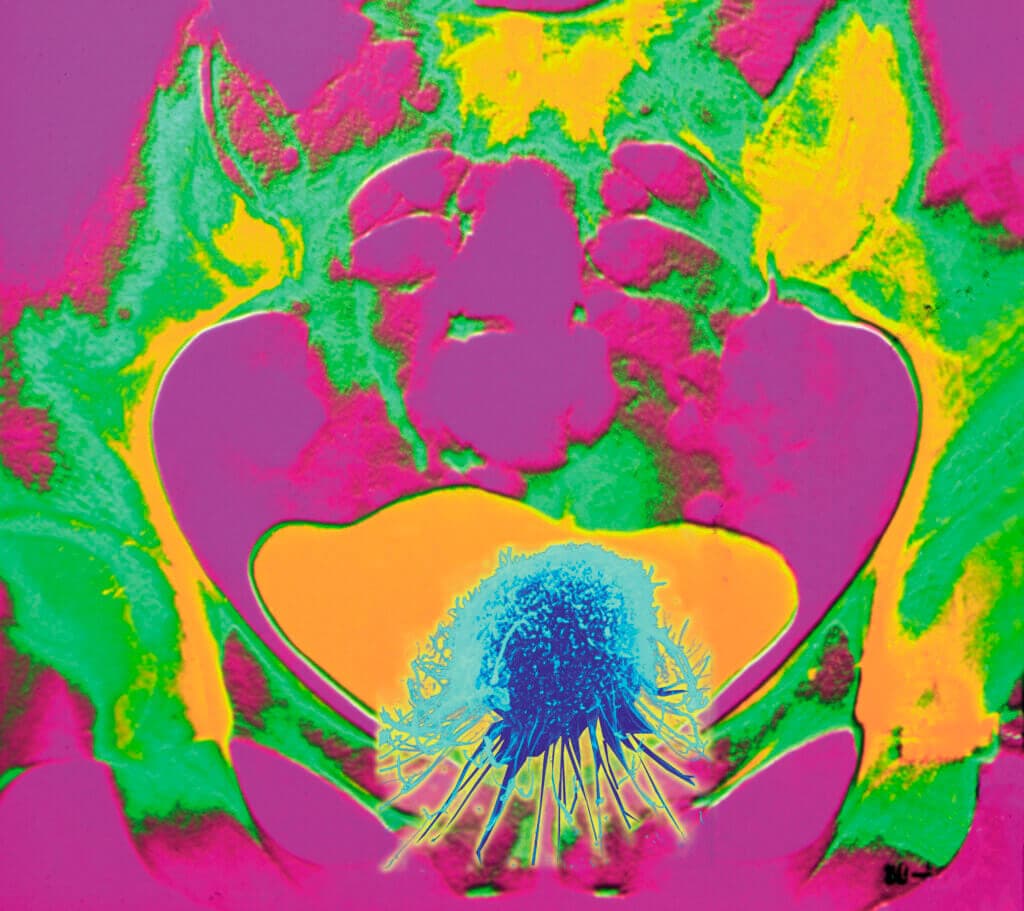 Bladder cancer. Conceptual coloured X-ray showing cancer of the bladder. The bladder is the large distended orange area at lower centre. The bones of the pelvis (green/orange) are seen around the bladder. Superimposed on the bladder is a coloured scanning electron micrograph (SEM) of a cancer cell. Bladder cancer is a fairly common type of cancer. The symptoms include passing blood in the urine an