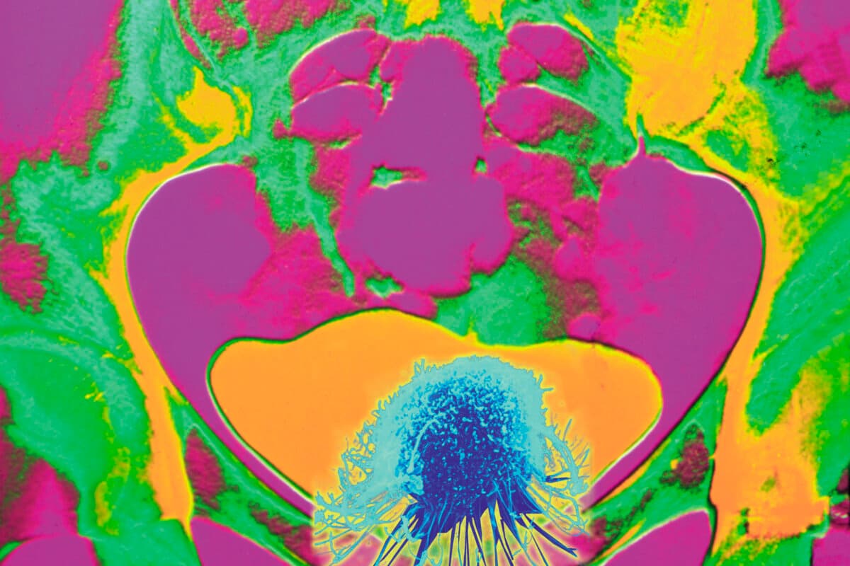 Bladder cancer. Conceptual coloured X-ray showing cancer of the bladder. The bladder is the large distended orange area at lower centre. The bones of the pelvis (green/orange) are seen around the bladder. Superimposed on the bladder is a coloured scanning electron micrograph (SEM) of a cancer cell. Bladder cancer is a fairly common type of cancer. The symptoms include passing blood in the urine an