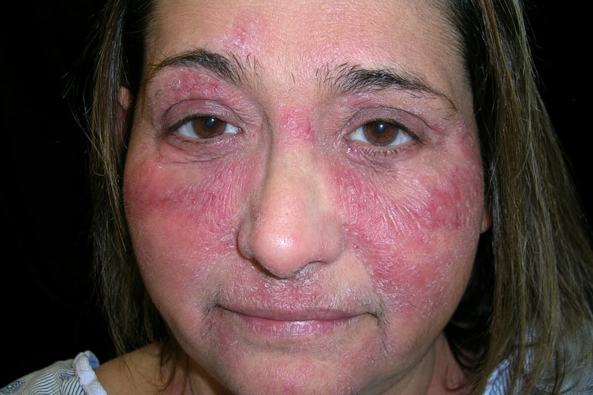 Atopic dermatitis on the face of a female patient in her 50s. Atopic dermatitis, also called atopic eczema, is an inflammatory skin reaction that occurs without any obvious external cause. It can be treated with soothing ointments and corticosteroid drugs.