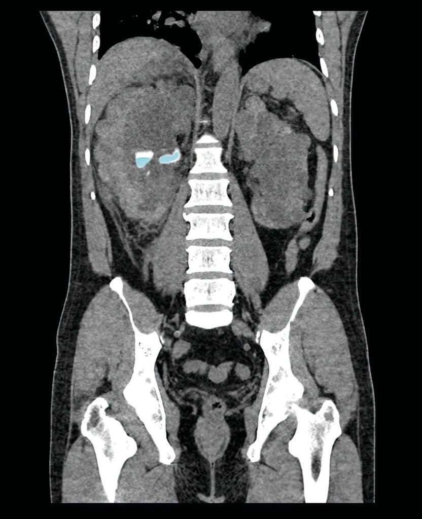 Coronal CT Scan of the Abdomen Showing Renal Stone in the Left K
