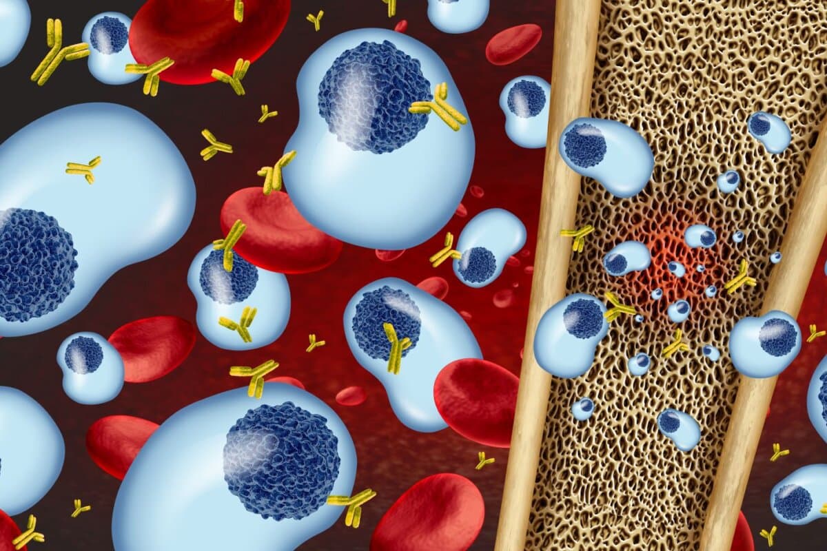 3D-Illustration eines Multiplen Myeloms mit entarteten Plasmazellen im Knochenmark.