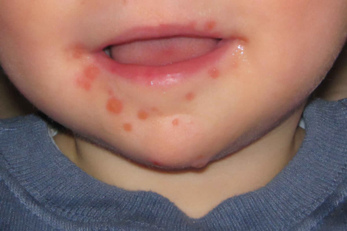 MT_CH_KW35_Derma_Hand_Foot_Mouth_Disease_MidgleyDJ