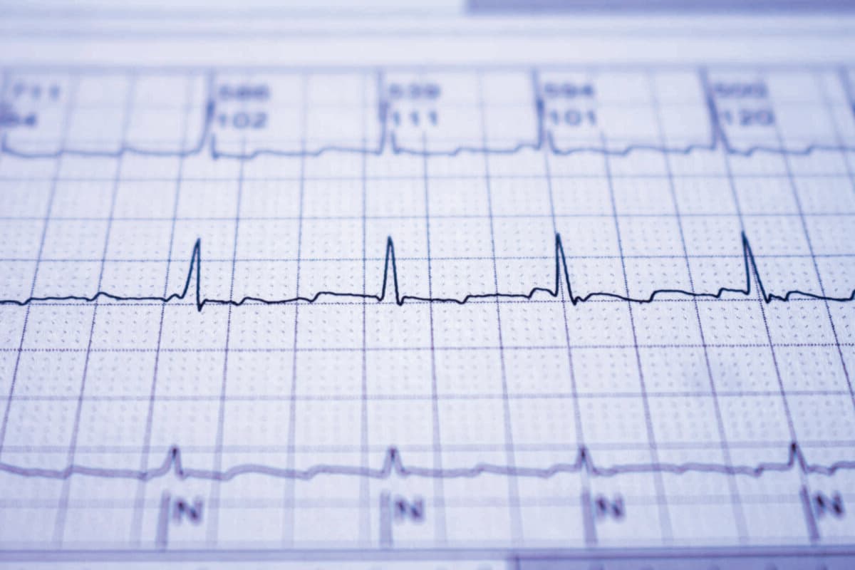 Electrocardiogram with cardiac arrhythmia. Atrial fibrillation r