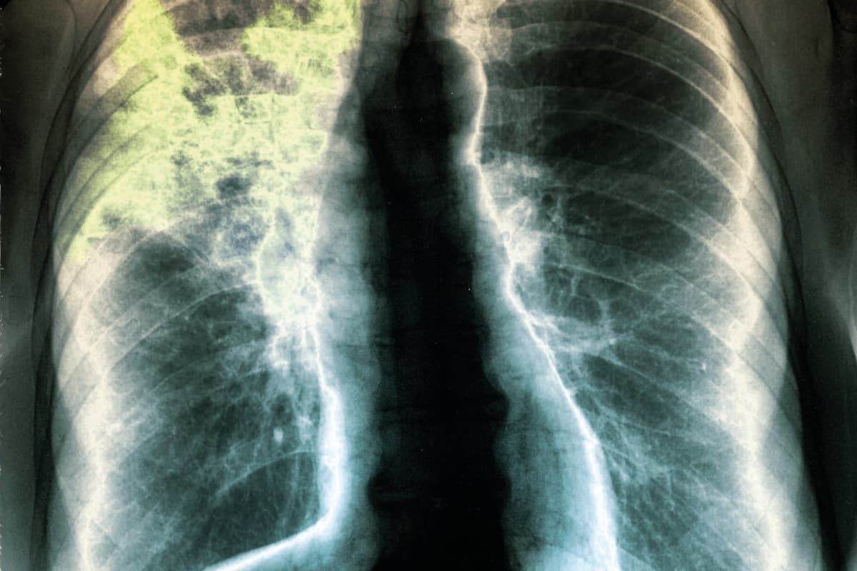 Pneumonia. Frontal chest X-ray of a 60-year-old patient,showing a opacity of the right apico-dorsal segment with air bronchogram,suggesting pneumonia. Pneumonia is an inflammatory condition of the lung that is usually caused by infection with viruses or bacteria.