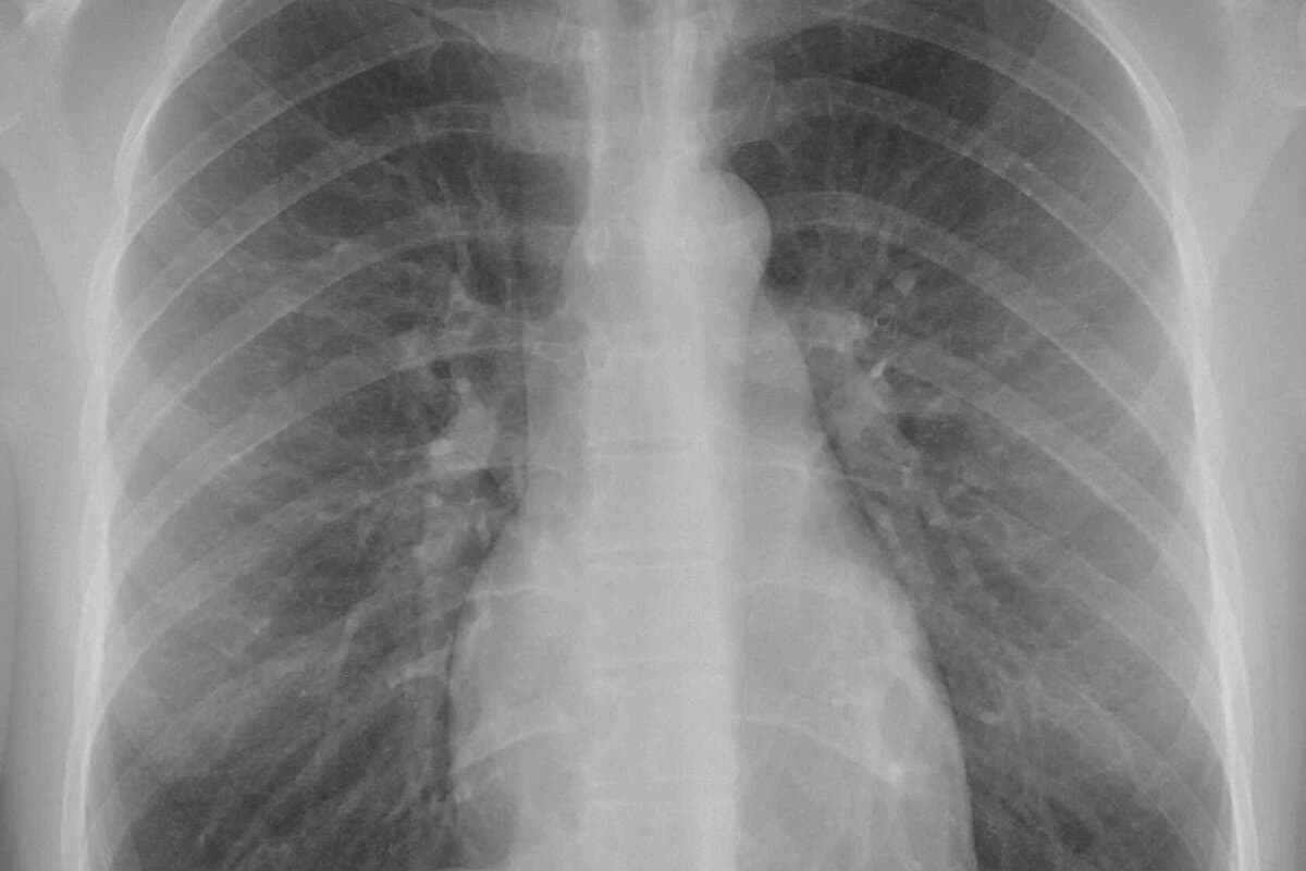 MT_CH_2026_KW40_PNEUMO_Normal_posteroanterior_PA_chest_radiograph_X-ray_wikimdeia_Mikael-Haeggstroem
