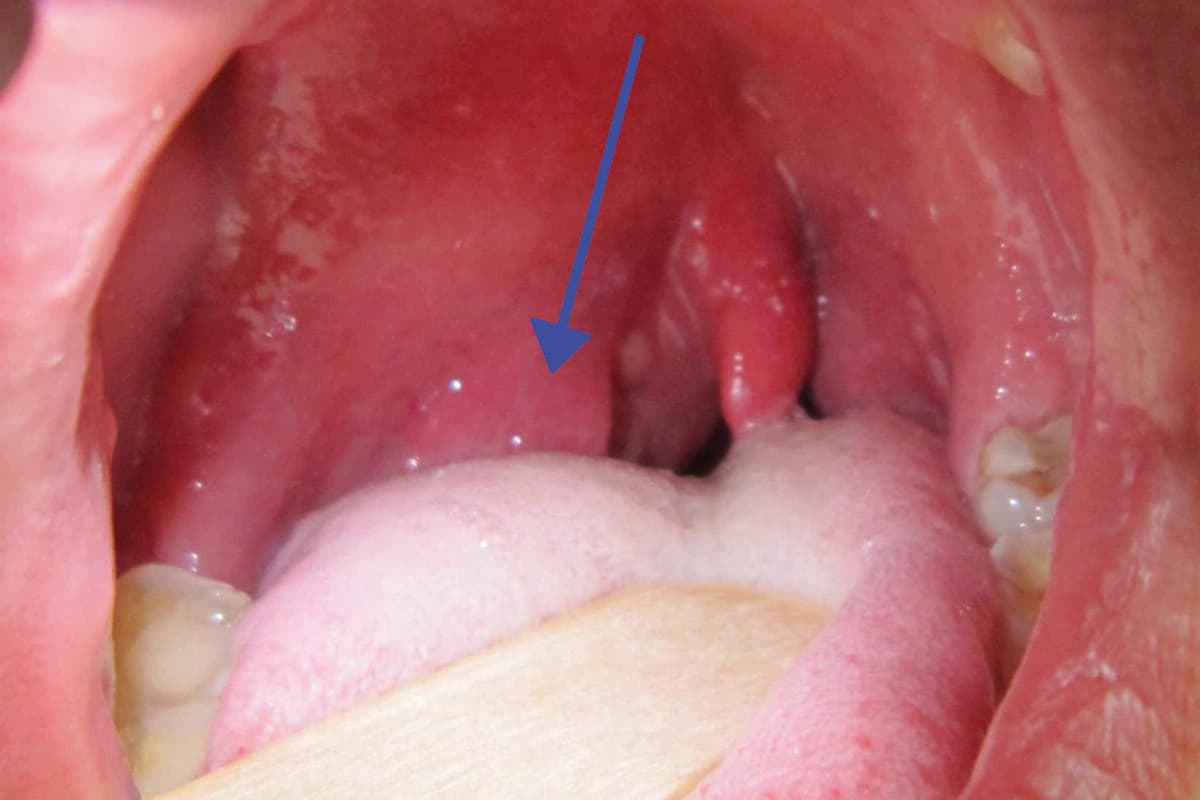 MT_CH_2026_KW40_PNEUMO_PeritonsilarAbsess_James-HeilmanMD