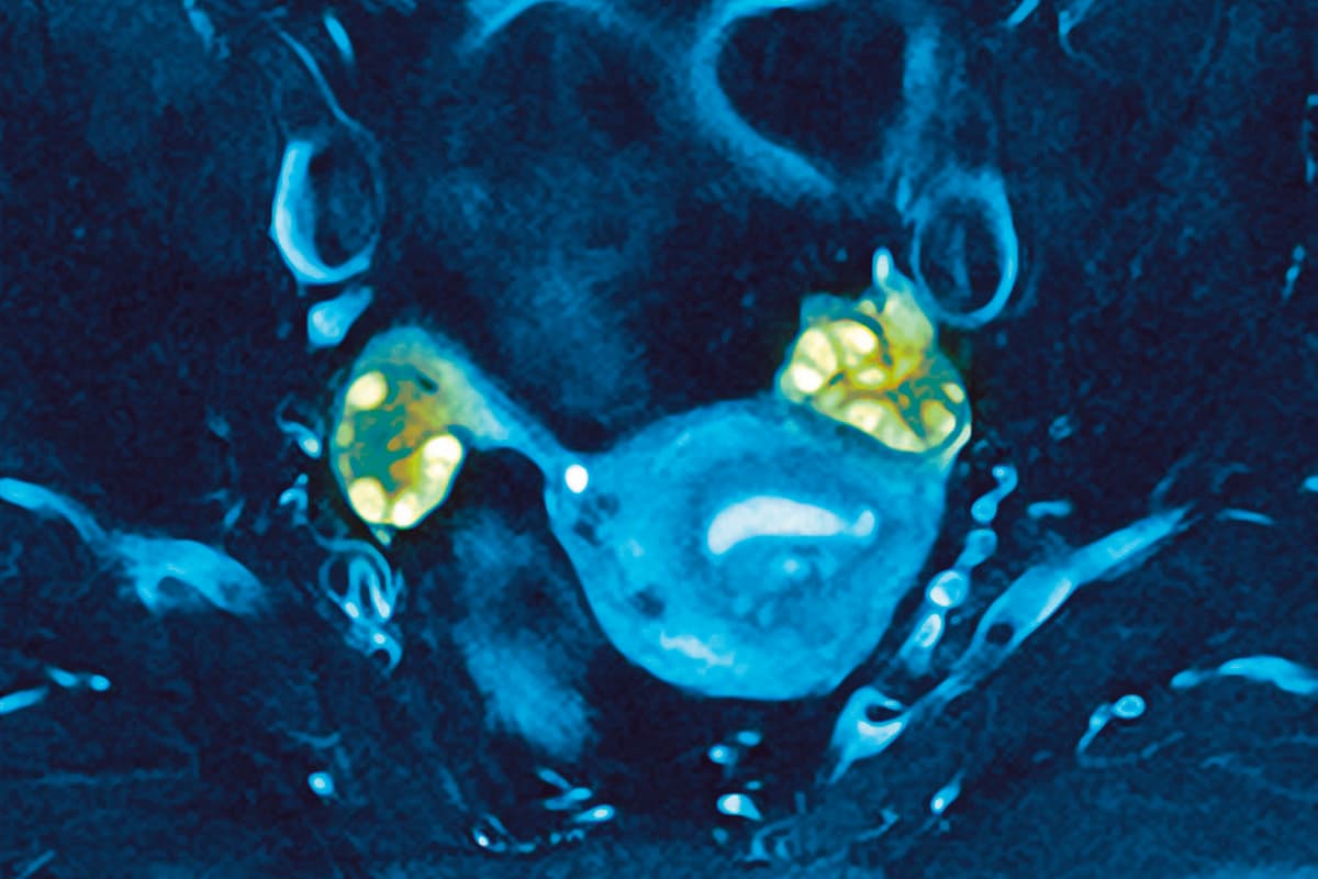 Polycystic ovaries. Magnetic resonance imaging (MRI) scan of a female patient with polycystic ovary syndrome (PCOS). PCOS,also known as Stein- Leventhal syndrome,is caused by hormone imbalances and results in multiple cysts (white) forming in the ovaries (green). A cyst is an abnormal fluid-filled cavity. Ovarian cysts can form when follicles fail to ovulate. Symptoms of PCOS are irregular or abse