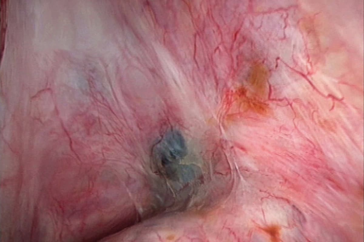 Endometriosis. Laparoscopic image of adhesions and endometriotic lesions (red) affecting the recto-uterine pouch (pouch of Douglas) of a 32-year-old female patient. Endometriosis is a condition in which cells from the lining of the uterus (endometrium) appear and flourish outside the uterine cavity, most commonly on the membrane which lines the abdominal cavity, the peritoneum. Symptoms of endomet