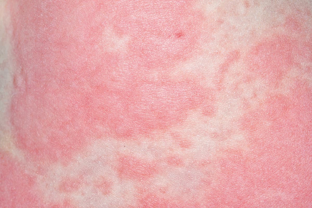 Urticaria. Close-up of urticaria (red) on a 1-year-old male patient following an episode of hand foot and mouth disease (HFMD). Urticaria,also known as nettle rash or hives,is a skin condition in which a rash of itchy wheals or lumps develops on the skin,usually on the trunk or limbs. The wheals appear in a matter of minutes and usually fade after a few hours. Urticaria most often occurs as an acu