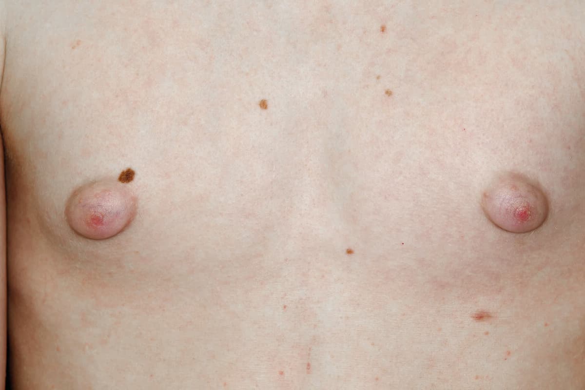 Enlarged nipples in a 12 year old male patient with gynaecomastia,breast development usually due to high levels of the female hormone oestrogen in the blood