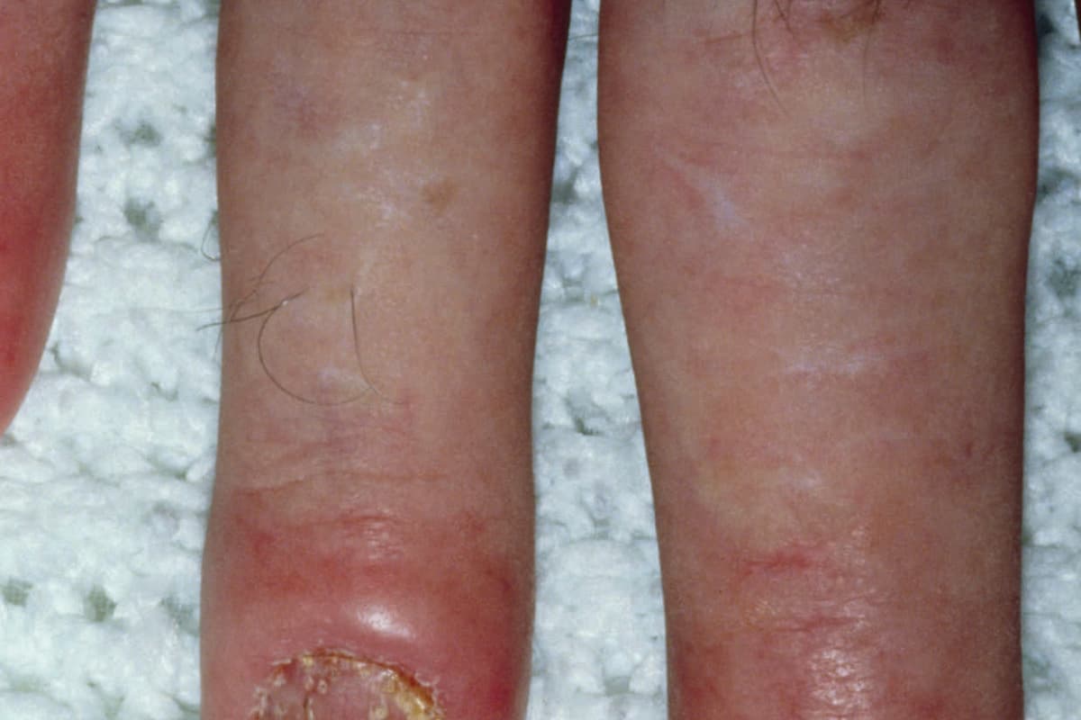 Arthropathic psoriasis affecting the joints and nails of a man's hand. Psoriasis,a chronic skin disease in which itchy,scaly,red patches form on the skin. It can also affect the growth of the finger & toe nails,as seen here,and in a small percentage of cases it is accompanied by arthritis in the small joints of the fingers,toes and spine. Psoriasis is one of the commonest skin diseases,but its cau