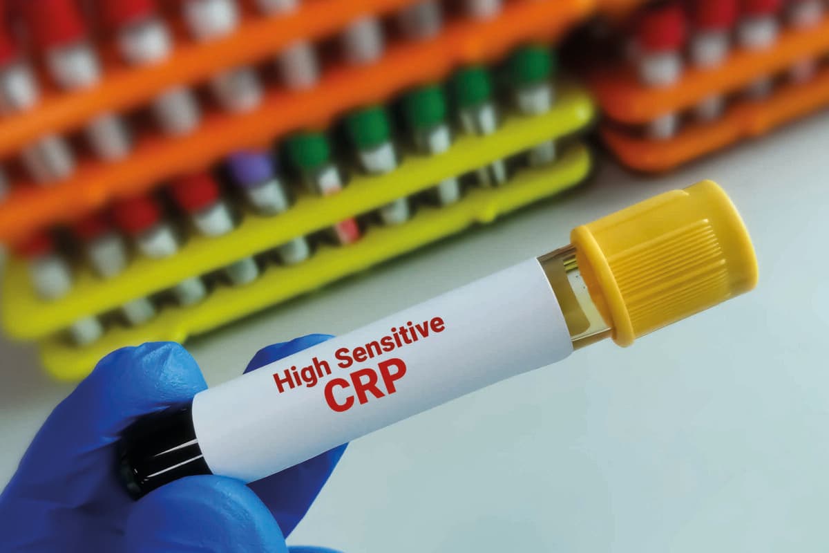 Blood sample tube for hs-CRP (high sensitive – CRP) test, for th