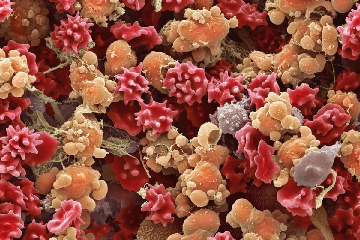 Cells from a urine infection. Coloured scanning electron micrograph (SEM) of crenated red blood cells,white blood cells and epithelial cells present in a urine sample taken from someone with a urinary tract infection (UTI). Magnification: x1650 when printed to centimetres wide