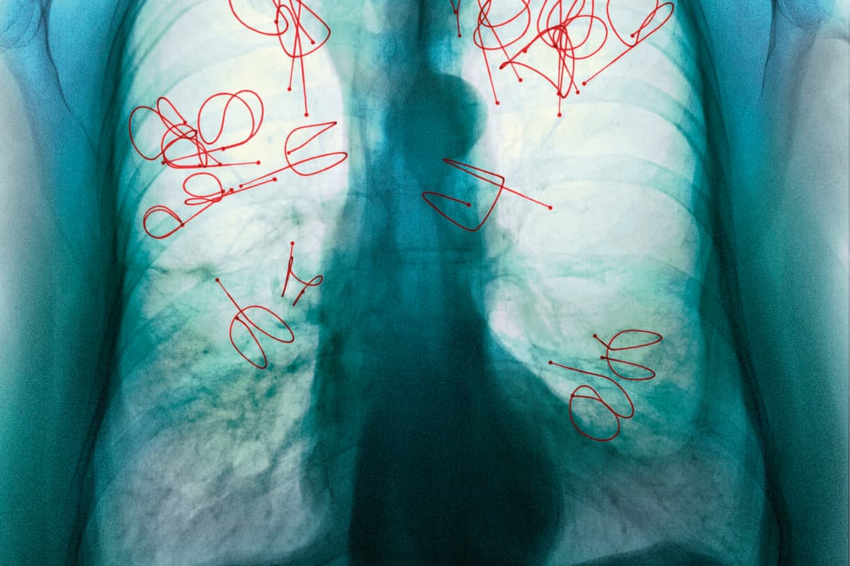 Endobronchial valves. Coloured X-ray of the lungs of a patient who has had endobronchial valves fitted to treat tuberculosis (TB)