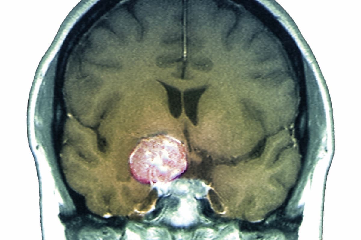 Brain tumour. Coloured magnetic resonance imaging (MRI) scan of a coronal section of the brain of a 47-year-old patient with a large meningioma brain tumour (orange, centre left). Meningiomas (meningeal tumours) are slow-growing benign (non-cancerous) brain tumours that form on the meninges, the membranous layers surrounding the brain and spinal chord. This meningioma has been calcified (hardened