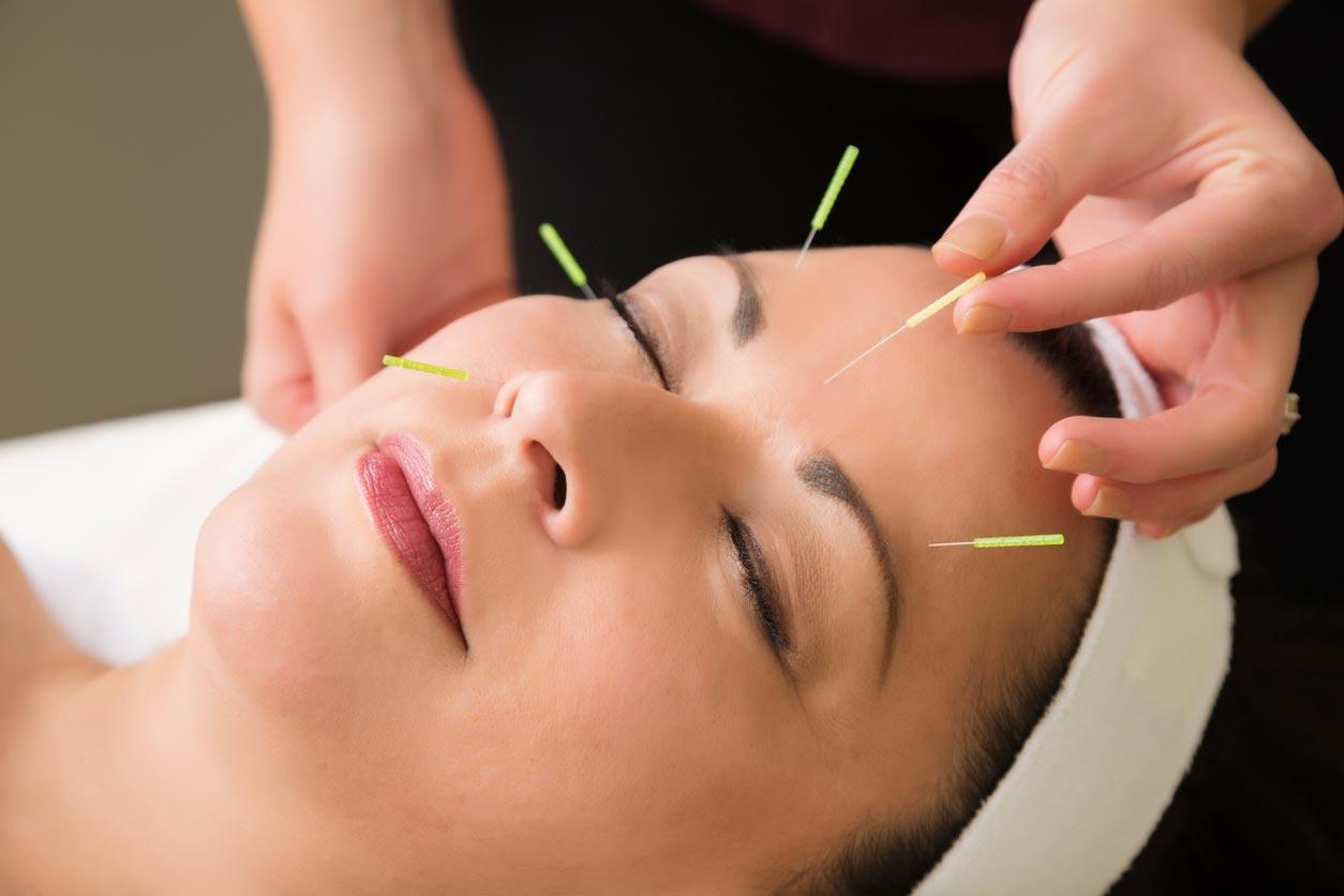 Frau bei der Akupunktur Behandung