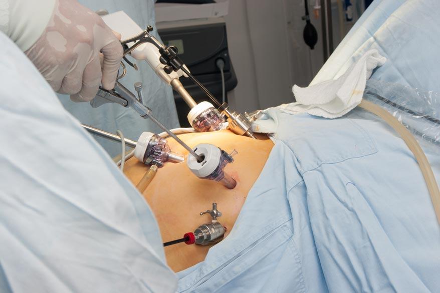 Bariatrische Operatione im Operationssaal