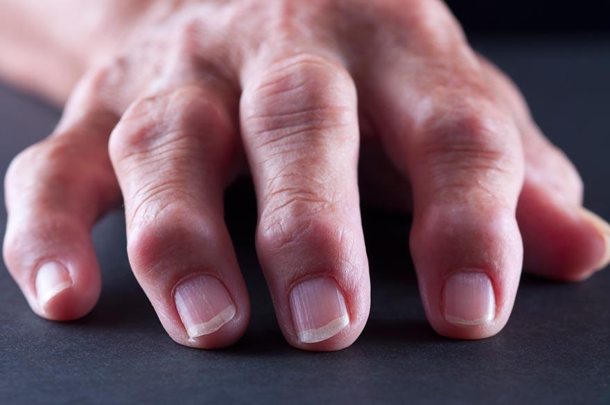 Die Hand einer Frau mit Arthrose
