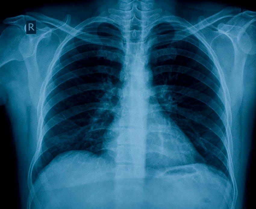 Röntgenbild der Brust