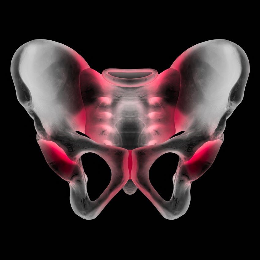 menschlichen Becken Knochen mit Gelenkschmerzen
