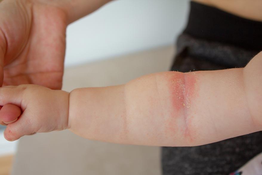 Psoriasis am Arm bei einem Kleinkind