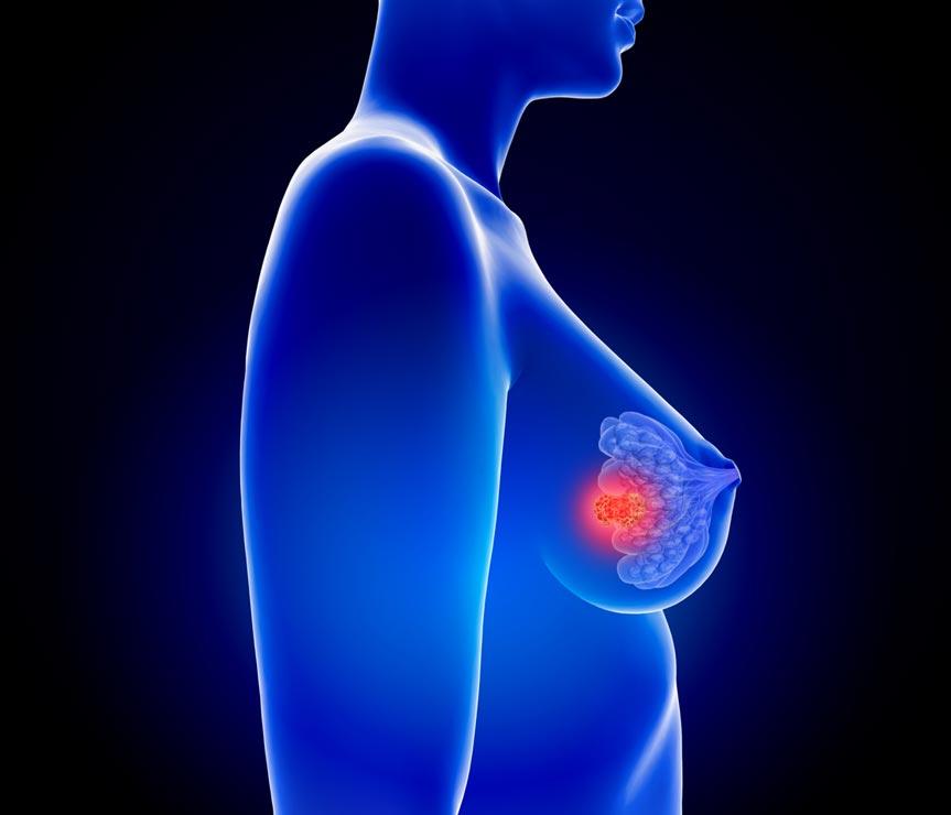 Illustration der weiblichen Brust mit Krebszellen