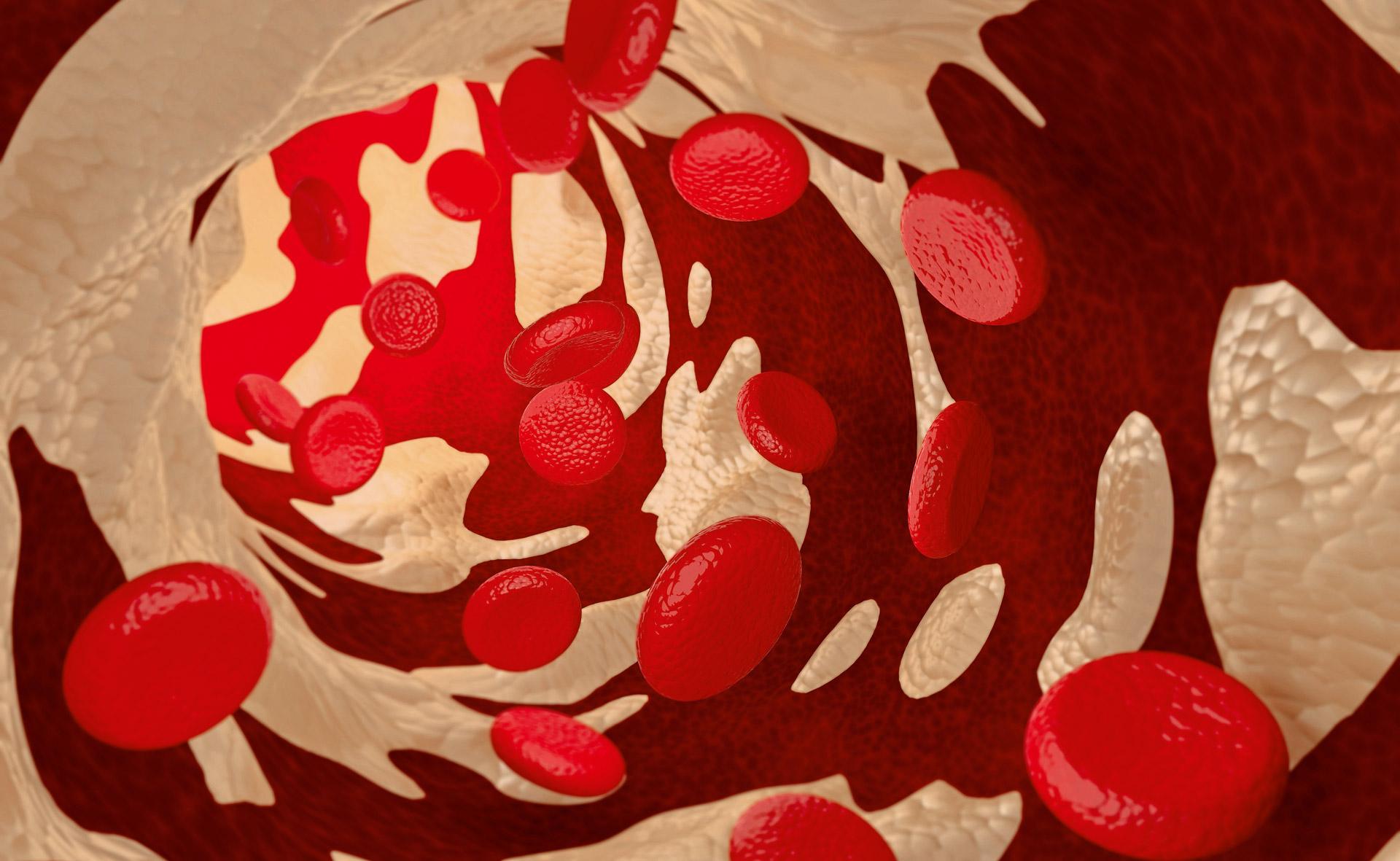Das LDL-Cholesterin ist die Ursache der atherosklerotischen Veränderungen in der Gefäßwand.