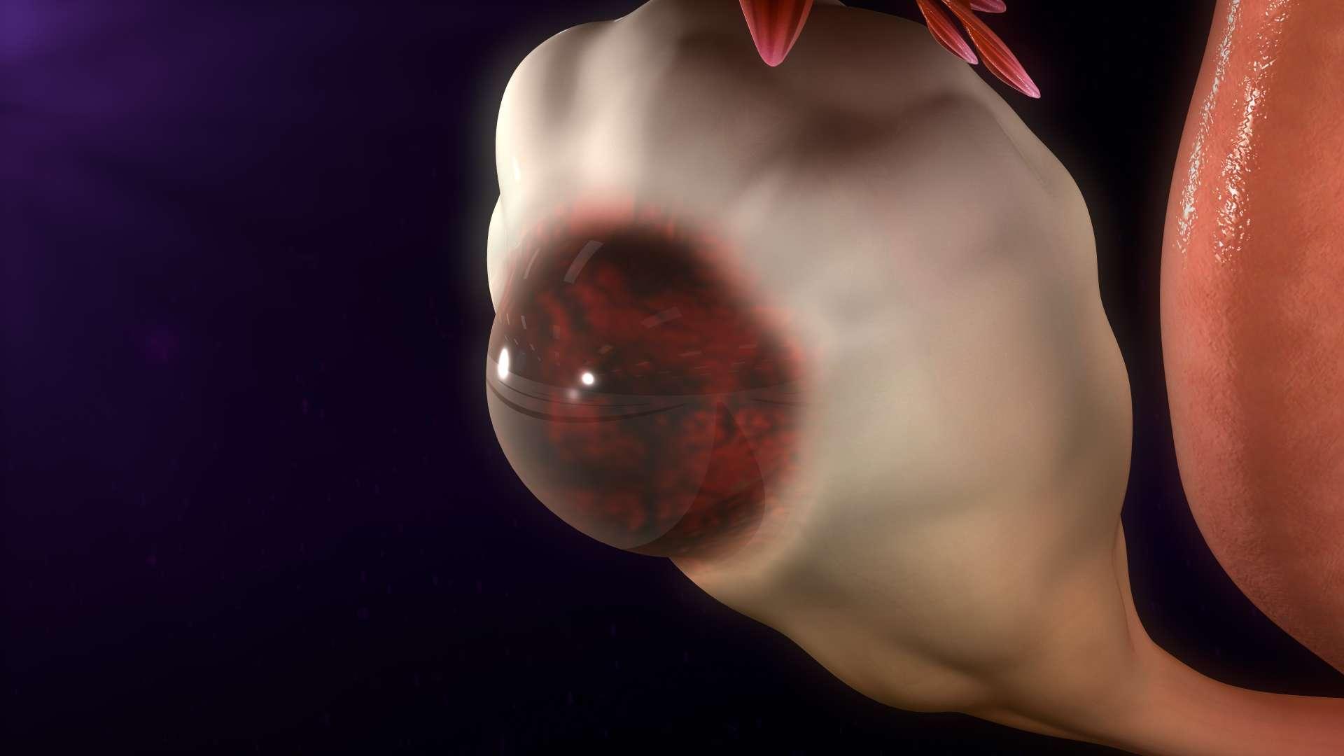 Eine Störung, bei der Gewebe, das normalerweise die Gebärmutter auskleidet, außerhalb der Gebärmutter wächst.