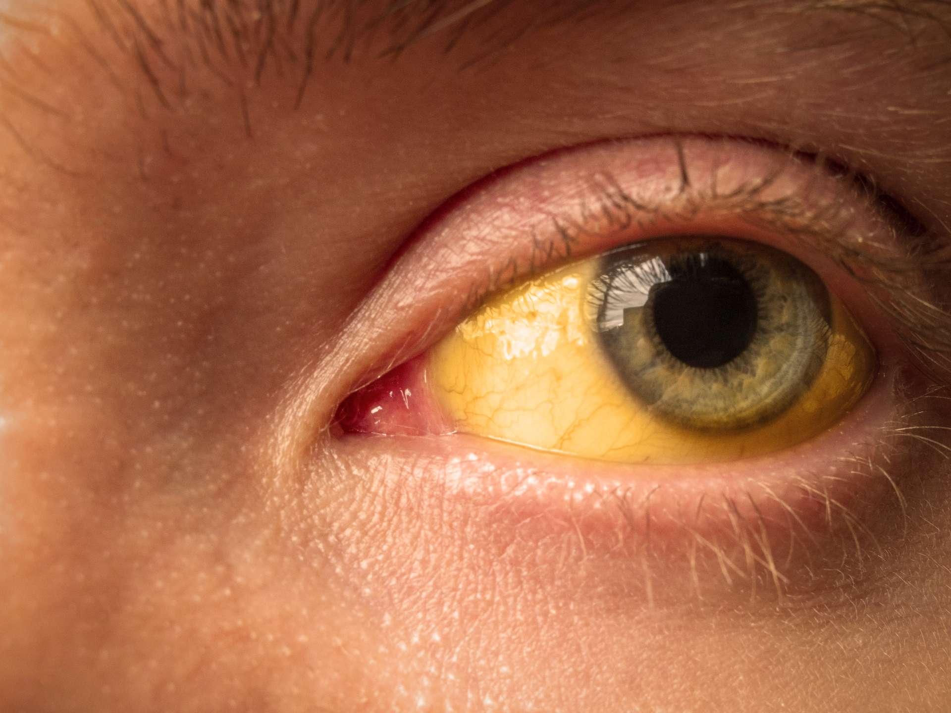 Gelbfärbung der Sklera des Auges bei Erkrankungen der Leber, Leberzirrhose, Hepatitis, Bilirubin