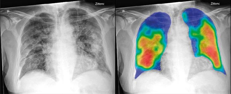 Röntgenbild der Lunge mit KI