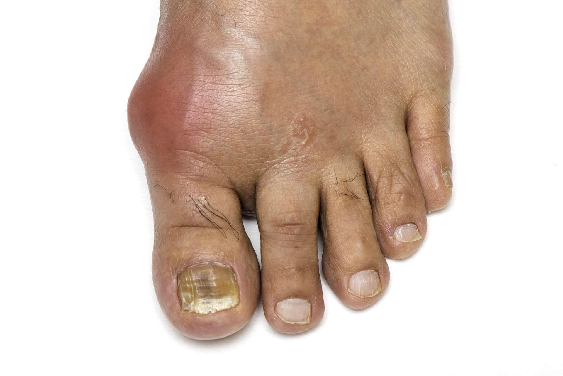 Fuß infiziert mit Gicht und Pilz Zehennagel