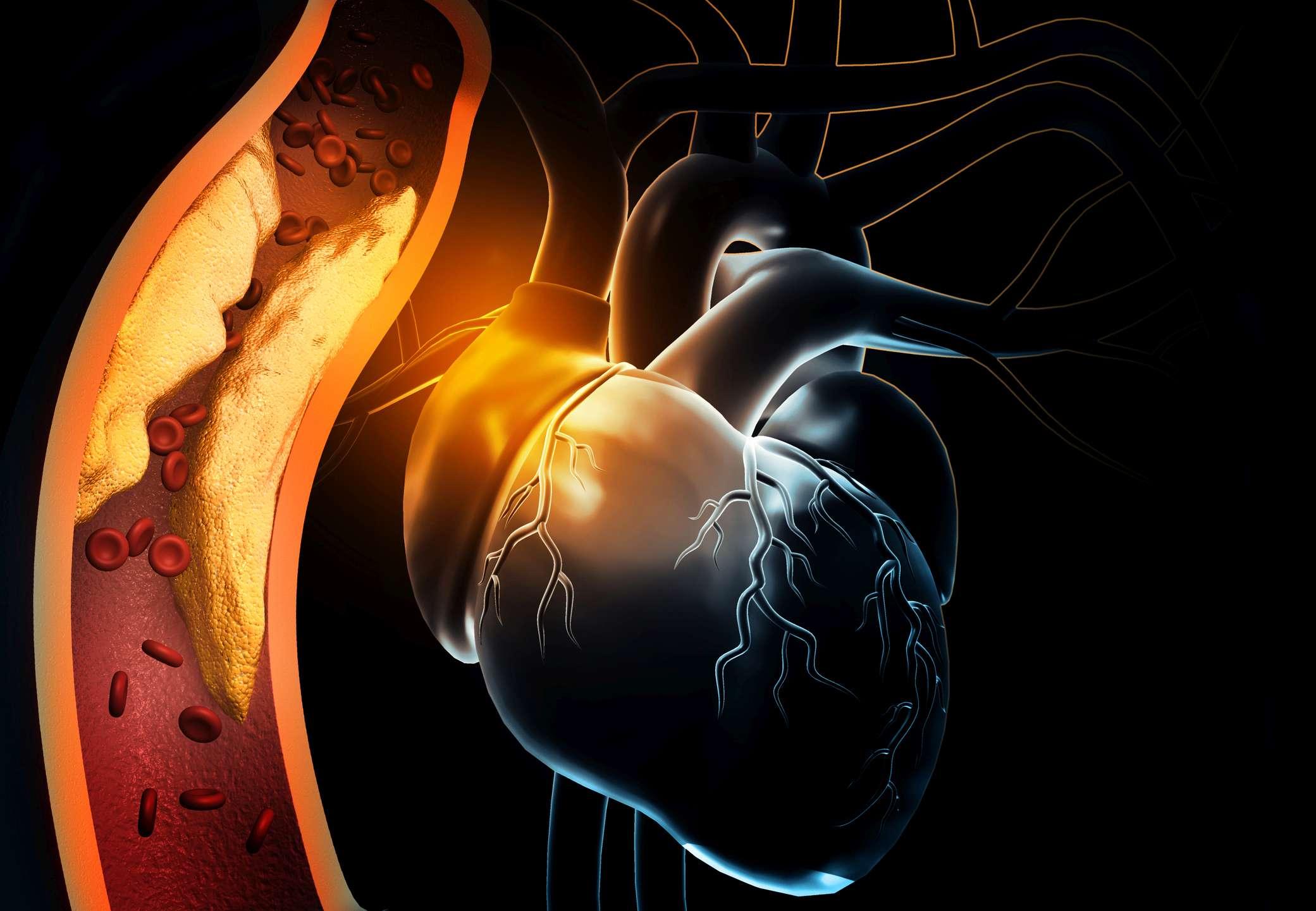 Menschliches Herz mit verstopften Arterien. 3D-Illustration