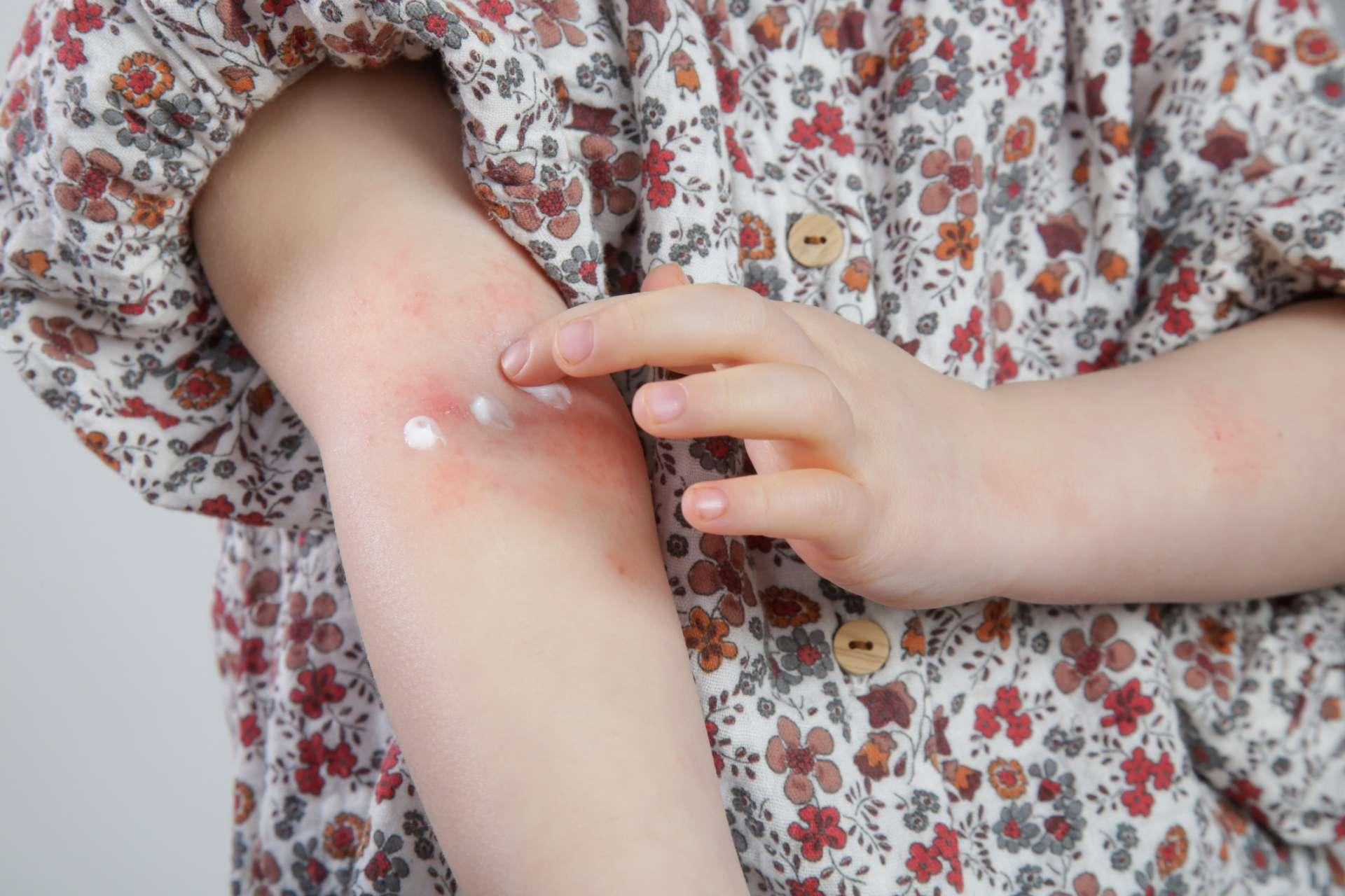 Kleinkindmädchen, das an atopischer Dermatitis leidet, Nahaufnahmebild. Rote und juckende Haut. Ekzem am Arm des Kindes.