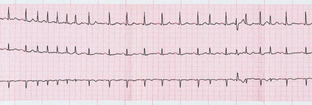 Notfallkardiologie. EKG mit supraventrikulären Extrasystolen und kurzen Anfällen von Vorhofflimmern