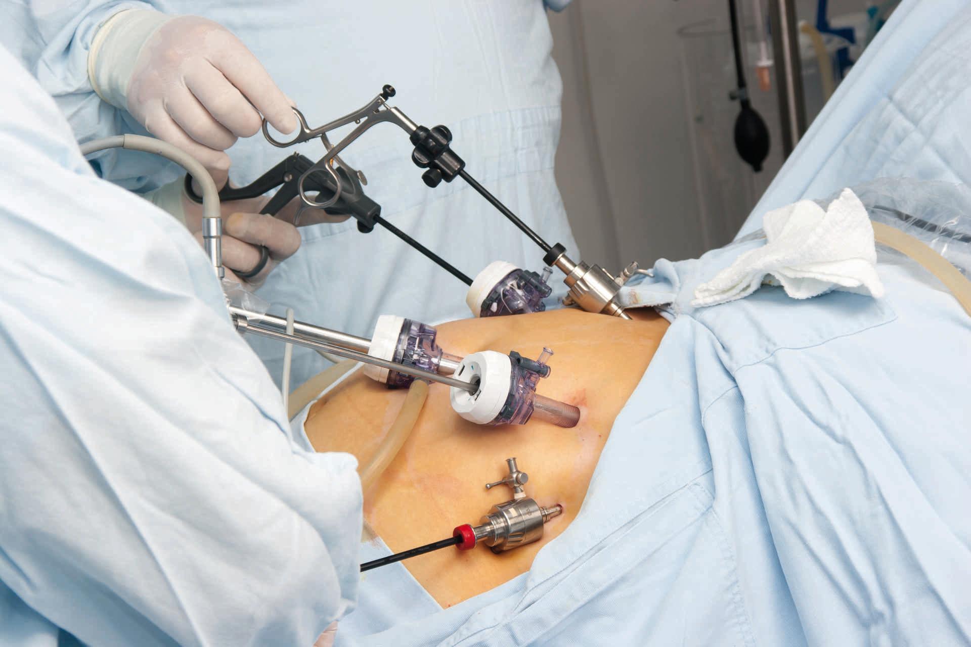 Porträt einer Magenbypass-Operation im Krankenhaus