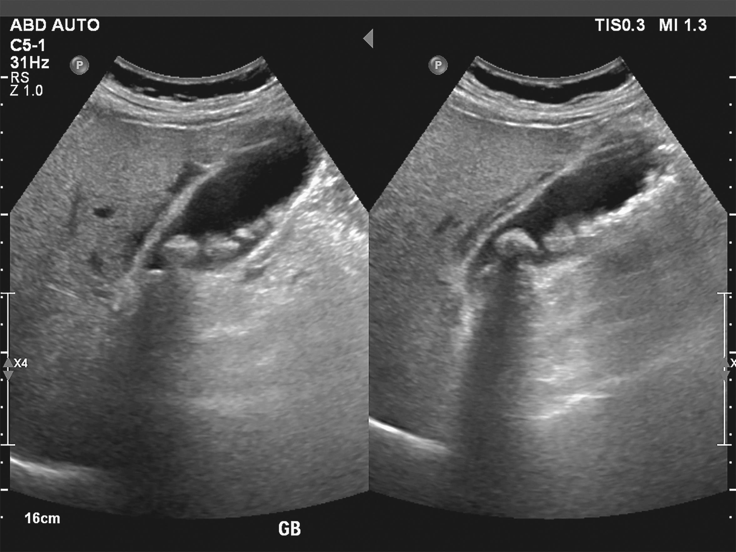 ultrasonography image of gallbladder with gall stones at upper abdomen