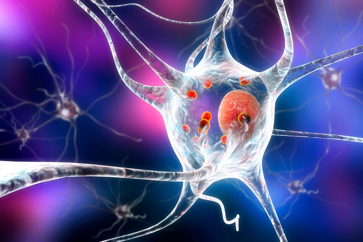 Neuronen in der Parkinson Krankheit