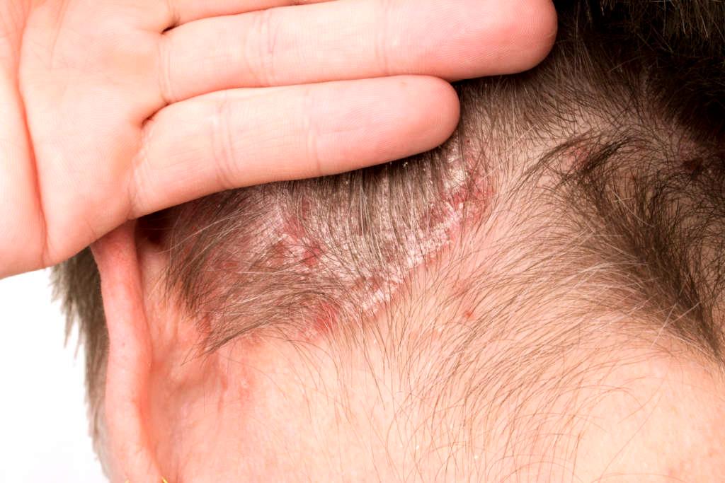 Detail of Psoriasis Vulgaris, skin disease