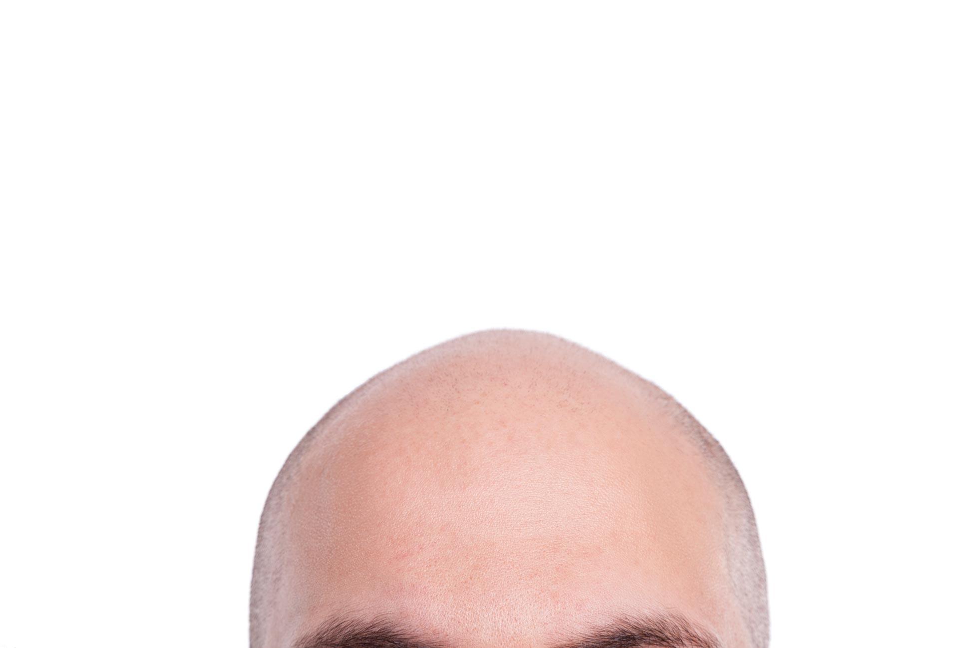 Ein Mann mit Glatze