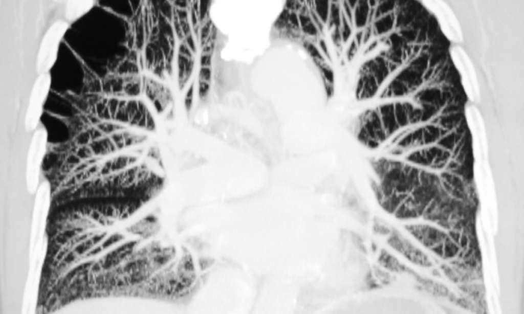 Computertomographisches Bild der Pulmonalarterie