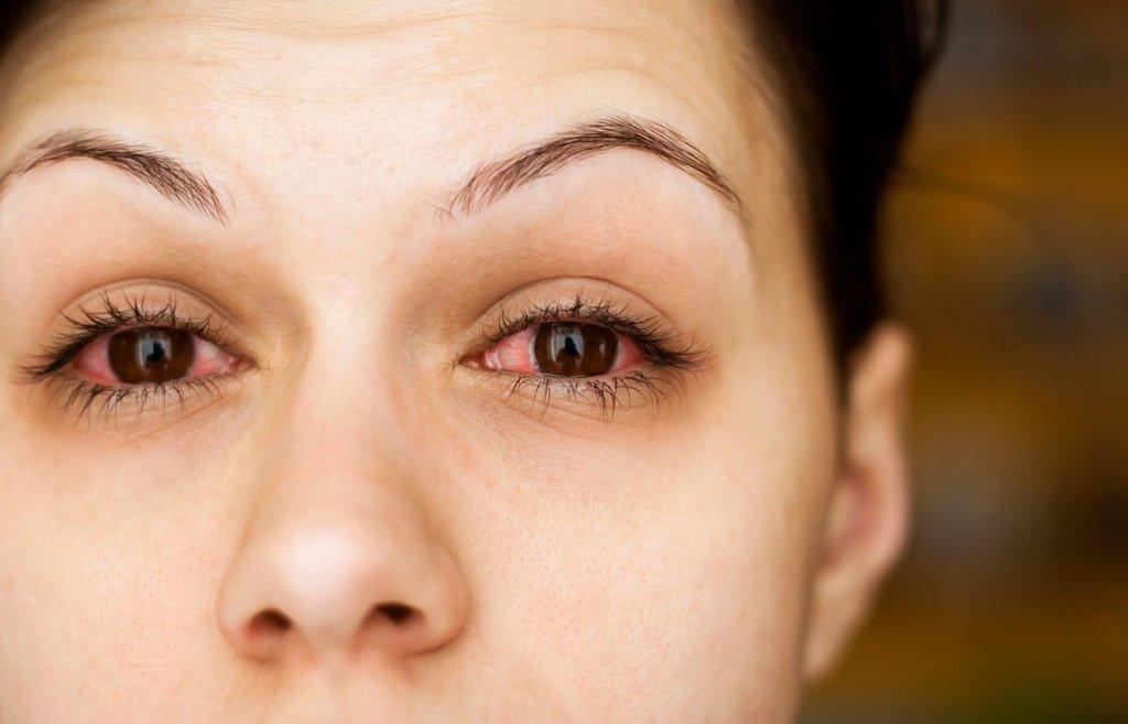 Frau mit Dermatologische Nebenwirkungen am Auge