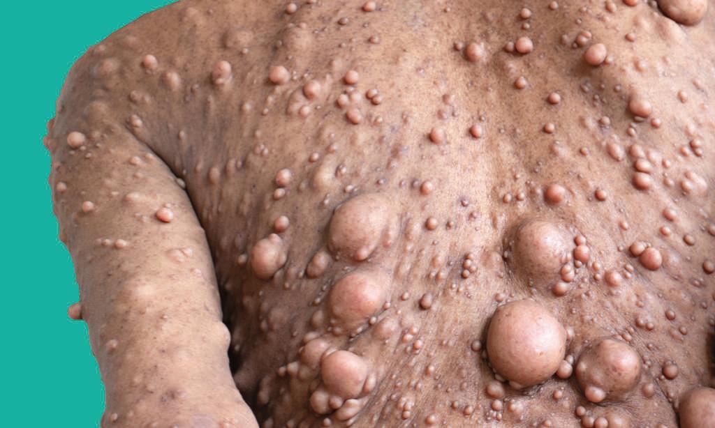 Neurofibromatosis (NF) is conditions in which tumors grow, symptoms include light brown spots on the skin.