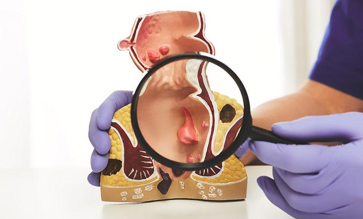 Proktologe mit Lupe zeigt rektale Erkrankungen an einem anatomischen Modell