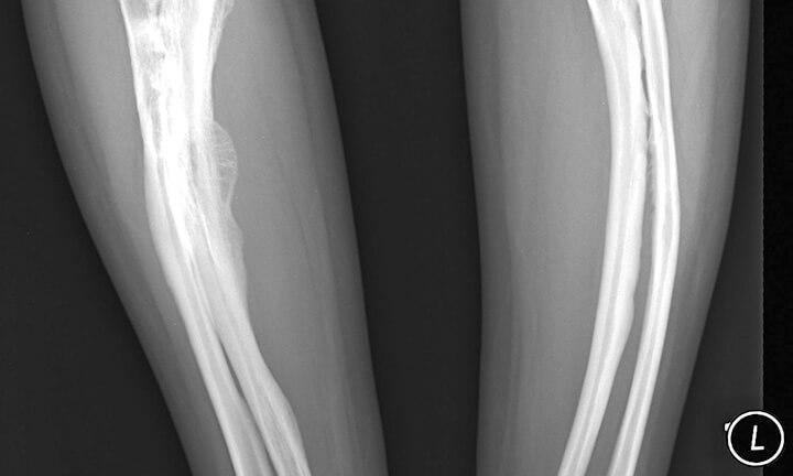 Röntgenbild zweier Beine Osteogenesis imperfectamit