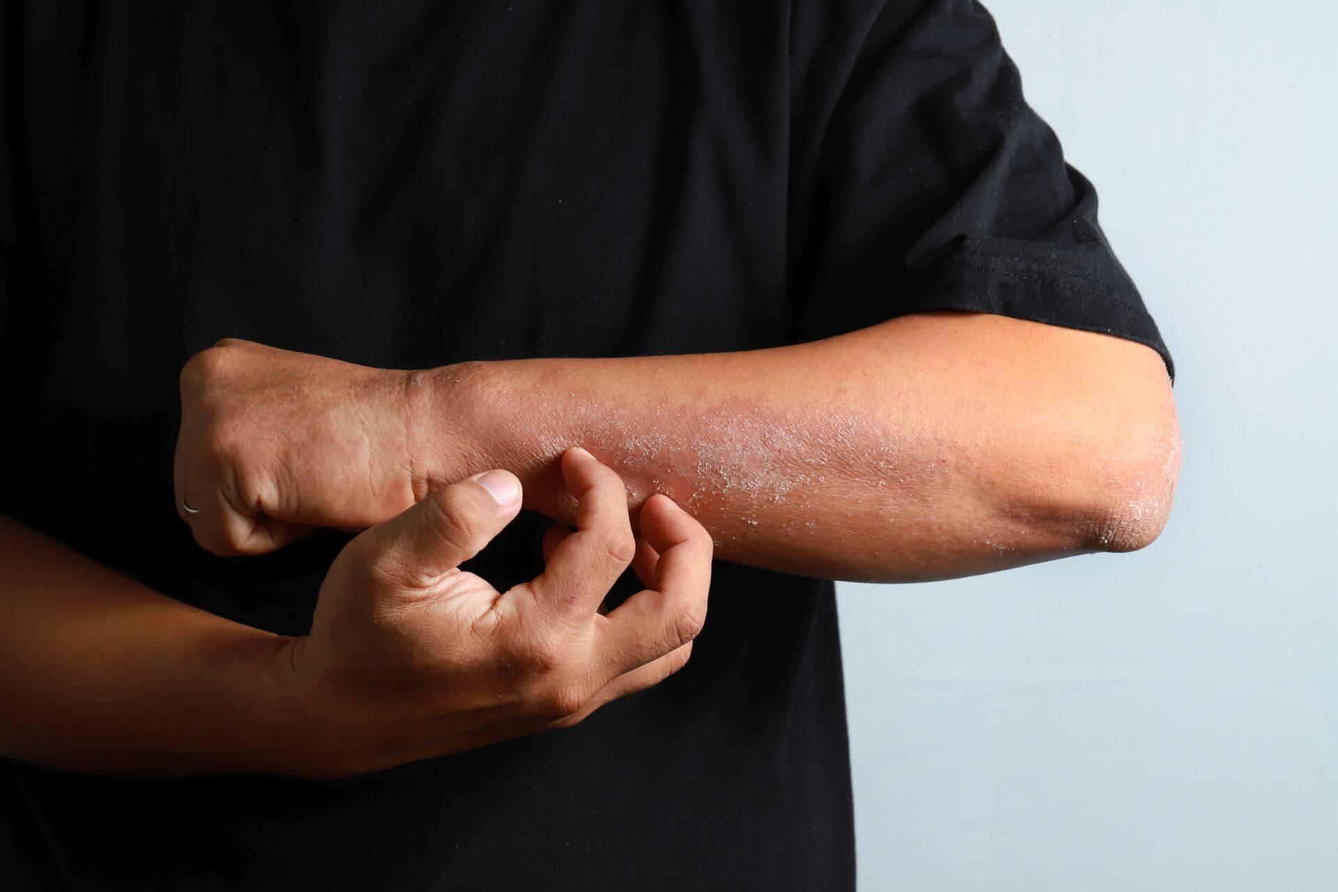 Spricht eine atopische Dermatitis nicht ausreichend auf topische Therapien an, muss systemisch behandelt werden.