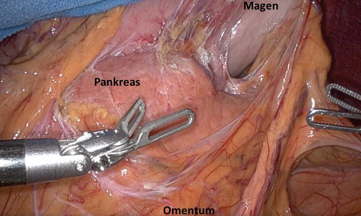Chirurgischer Eingriff an der Pankreas mit Roboter-Technik