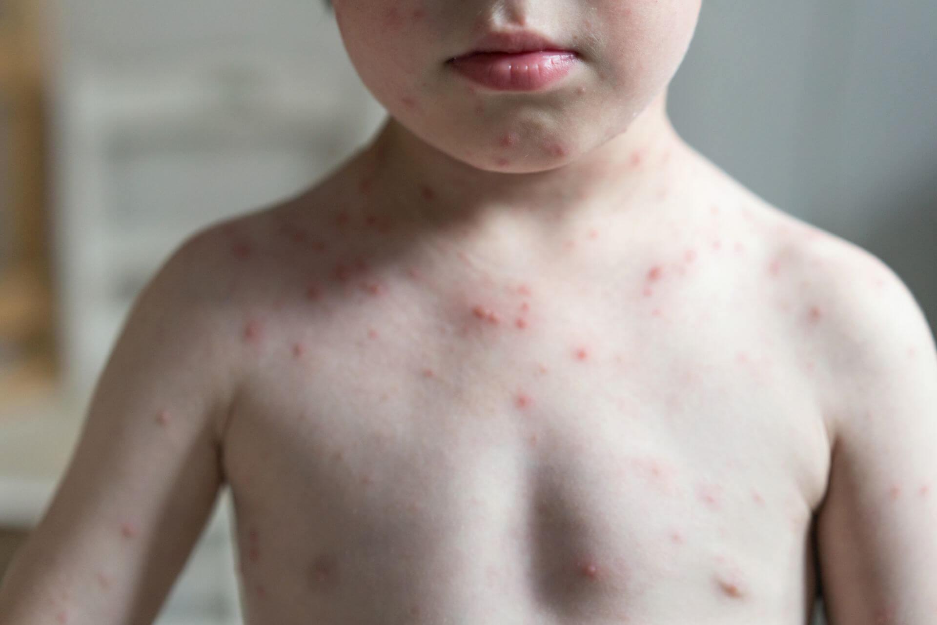 Hautausschläge bei Kindern sind zumeist harmlos, können aber auch ernstzunehmende Hintergründe haben.