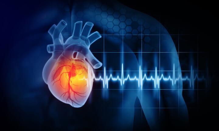 Herzinfarkt und Herzerkrankungen. 3D-Darstellung